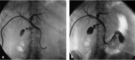 Management of Malignant Obstructive Jaundice {faces}